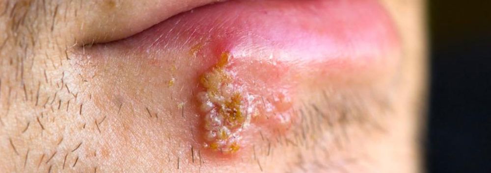 Signs that tell you might have herpes Â» blog ...