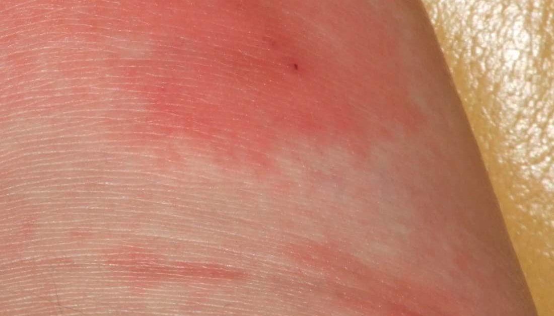Skin infection pictures and treatments