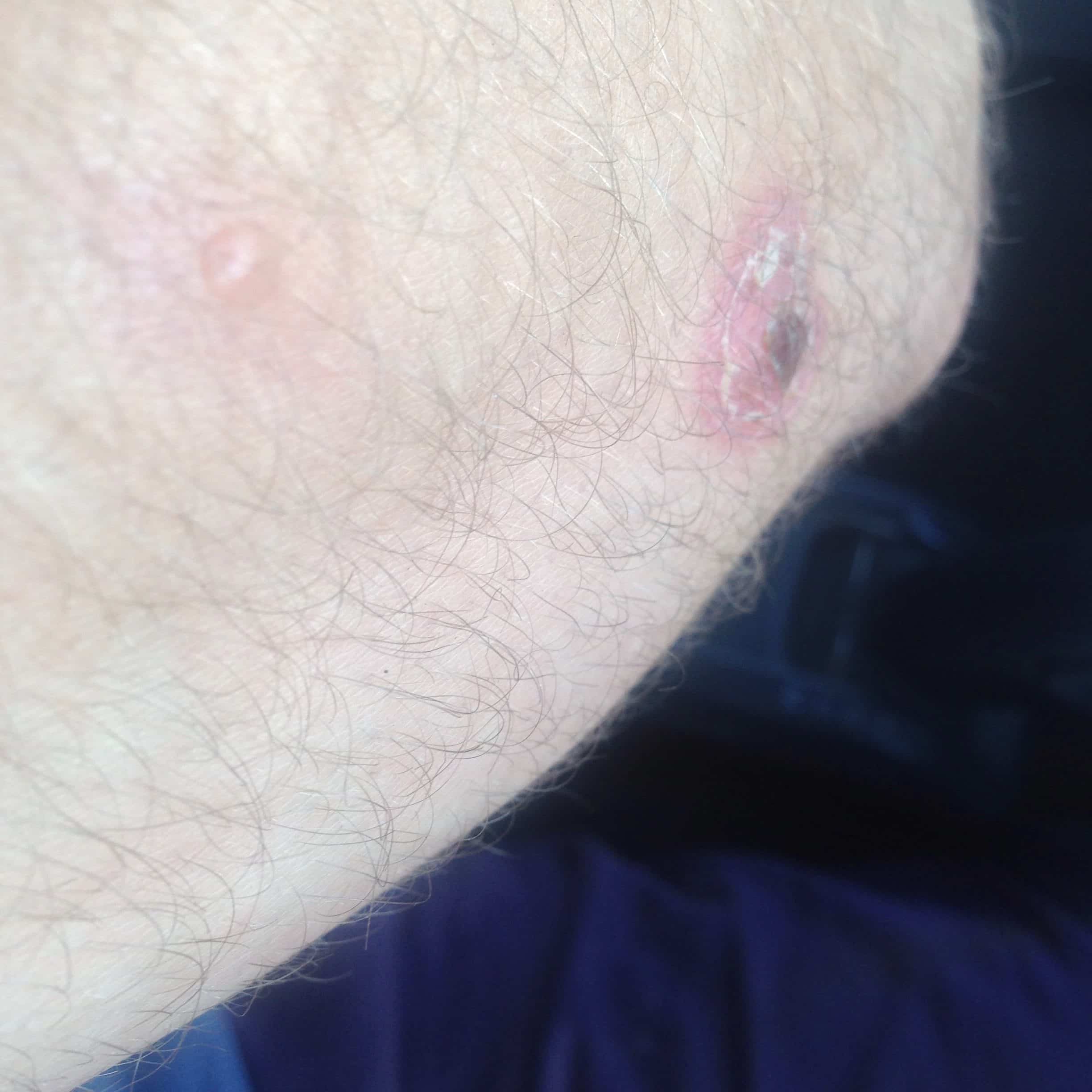 Small itchy blisters appearing on arm turning into sores. (doctor ...
