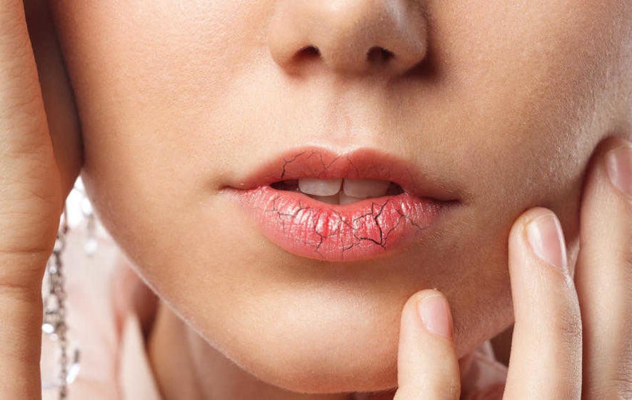 Solutions for sore lips