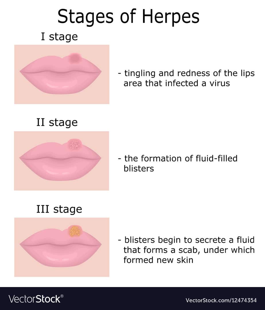 Stages of Herpes Royalty Free Vector Image