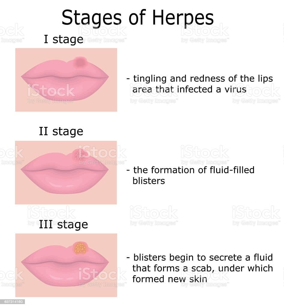 Stages Of Herpes Stock Vector Art &  More Images of Abscess 637314160 ...