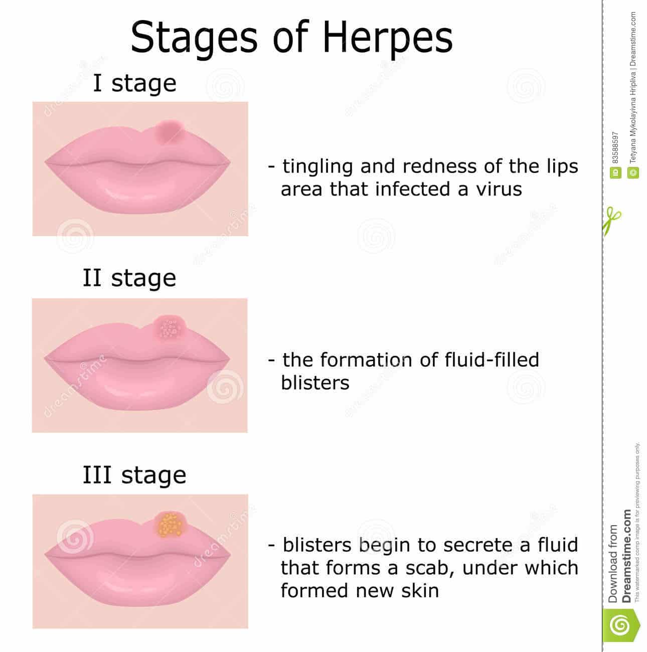 Stages of Herpes stock vector. Illustration of medical