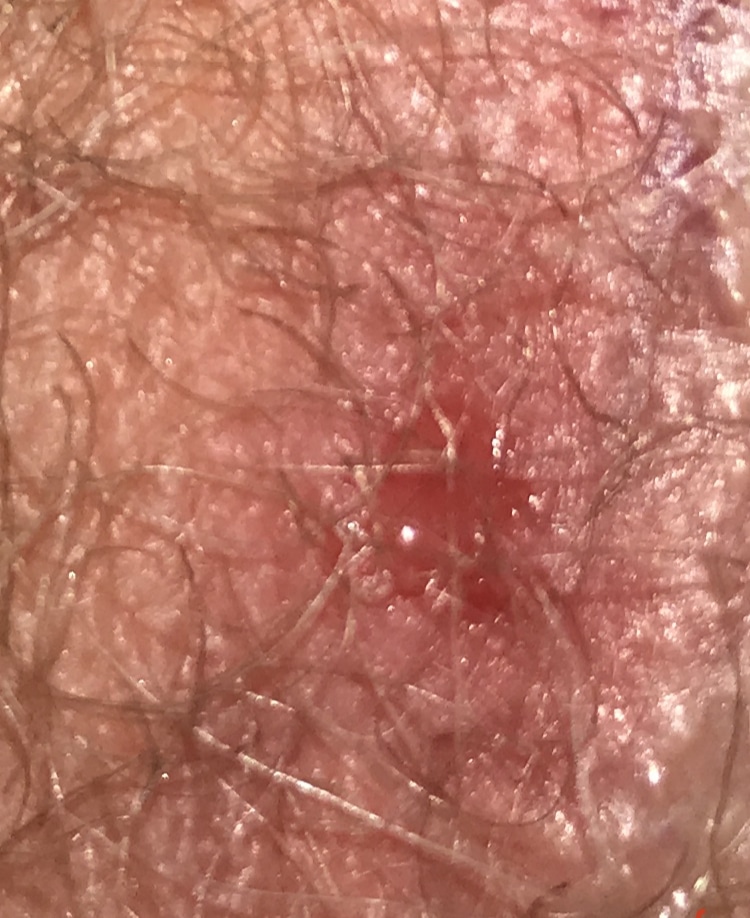 TERRIFIED!! Herpes finally showed up? (Pics)