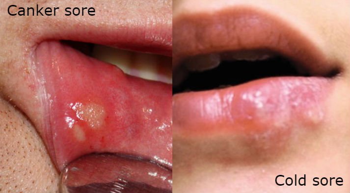 The Best Canker Sore Product of 2020 [Fastest OTC Solutions]