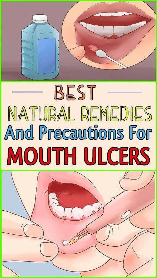 The Best Natural Remedies and Precautions For Mouth Ulcers