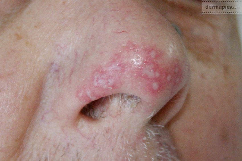 The Herpes Can Be Prevented By Using Certain Measures