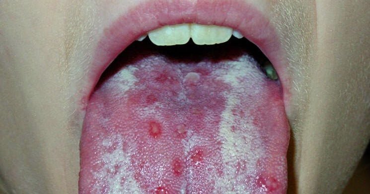 The Herpes Simplex Roof Of Mouth