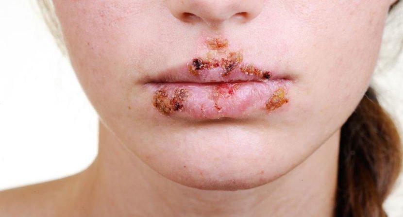 Tips to manage herpes outbreak Â» Howdywellness.com