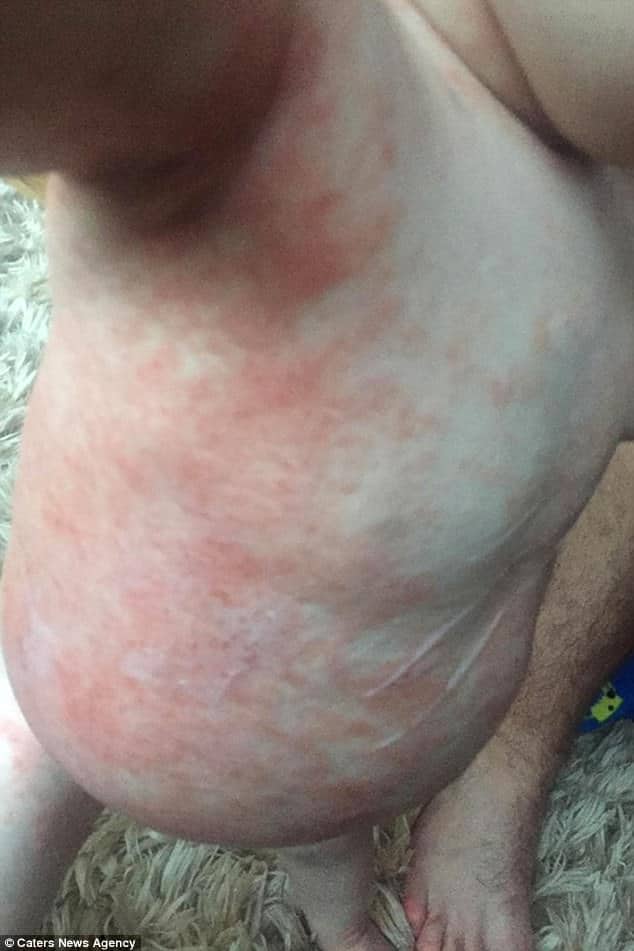 Toddler nearly died after catching herpes from a kiss