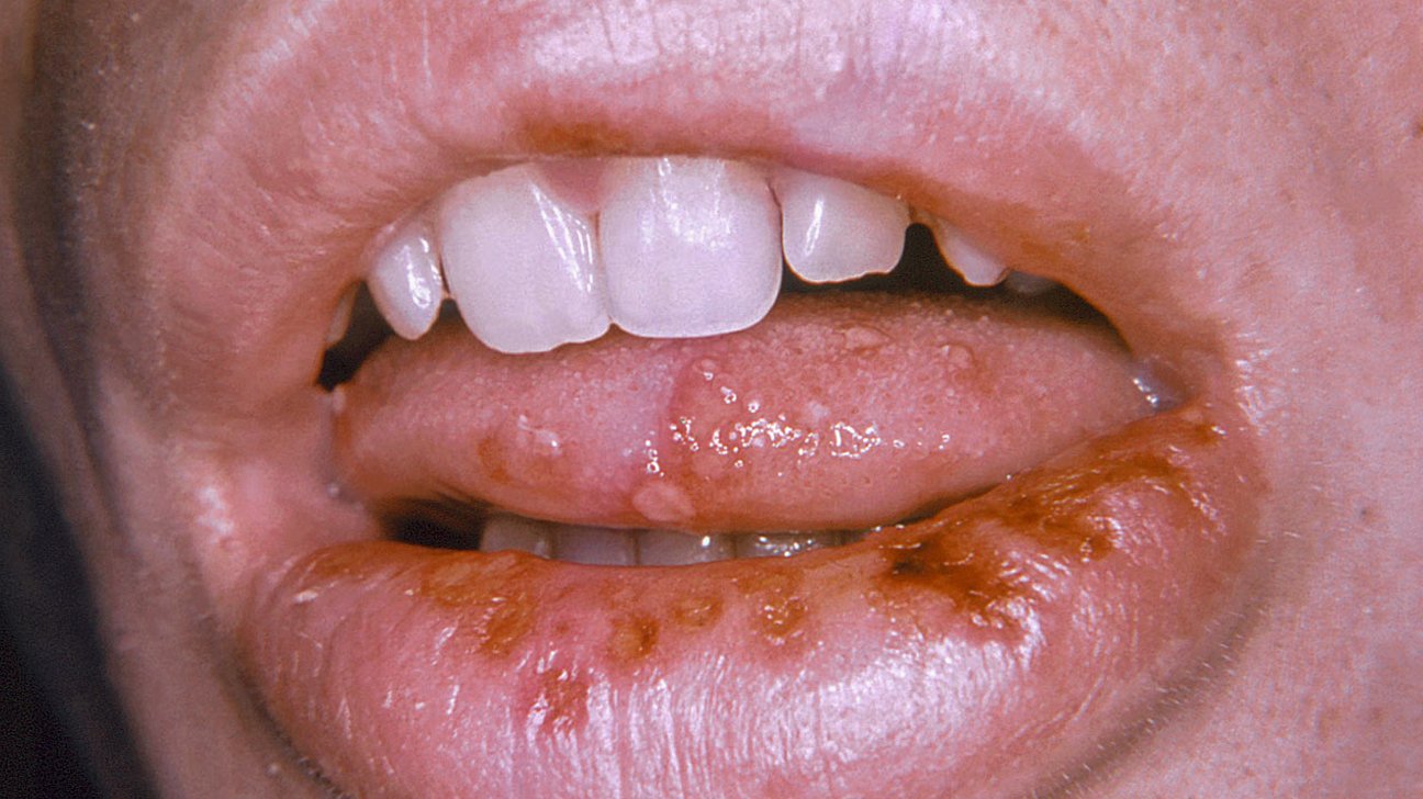 Tongue Herpes: How to Identify, Treat, and Prevent