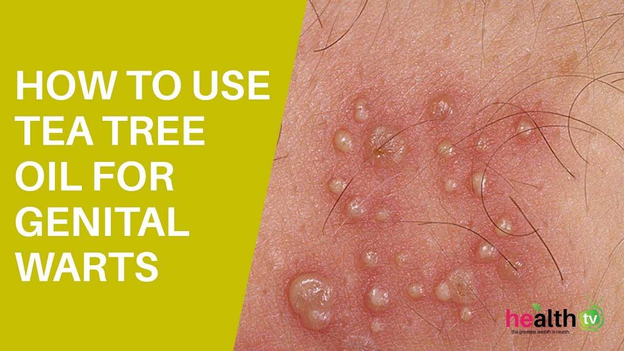Treat Genital Warts With Tea Tree Oil