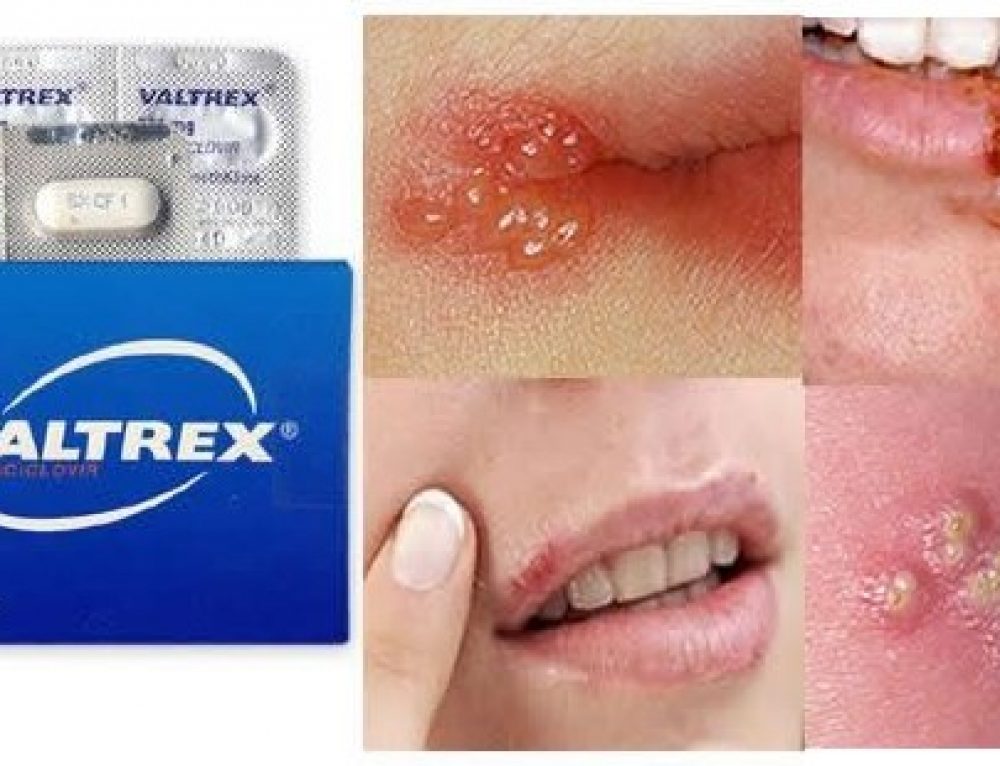 Treating A Herpes Outbreak With Valtrex