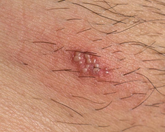 Treatment for Shingles Blisters