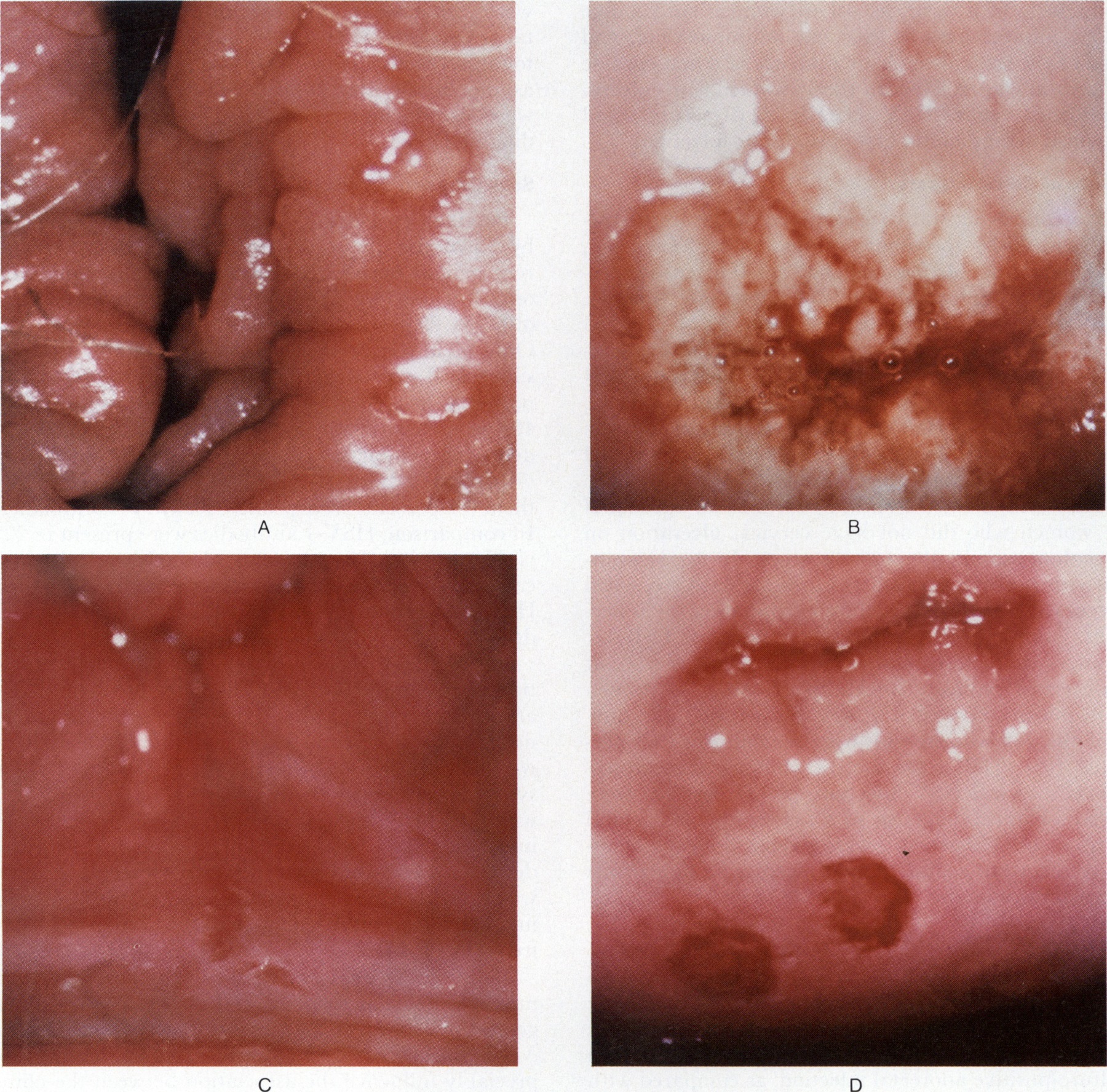 Underdiagnosis of Genital Herpes by Current Clinical and Viral ...