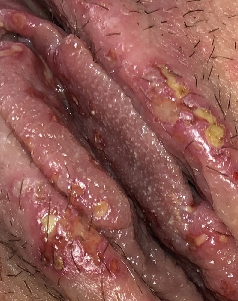 Unsure if its herpes please help