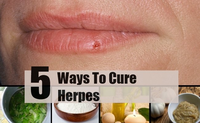 Various 5 Best And Effective Ways To Cure Herpes