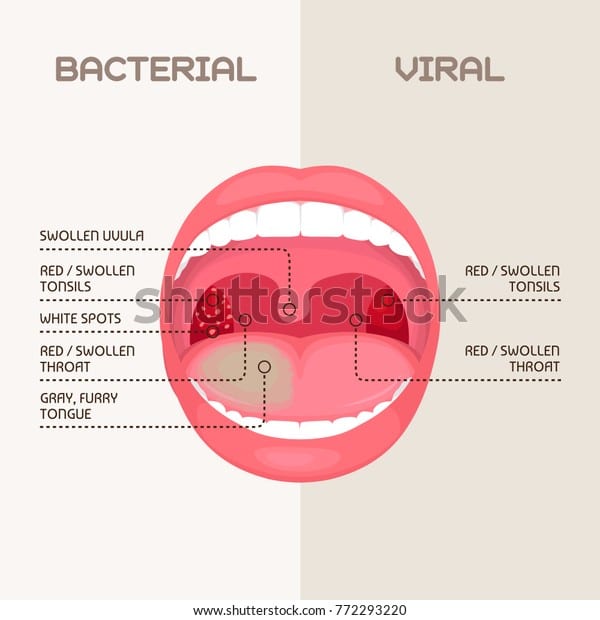 Vector Illustration Throat Bacterial Viral Infection Stock Vector ...