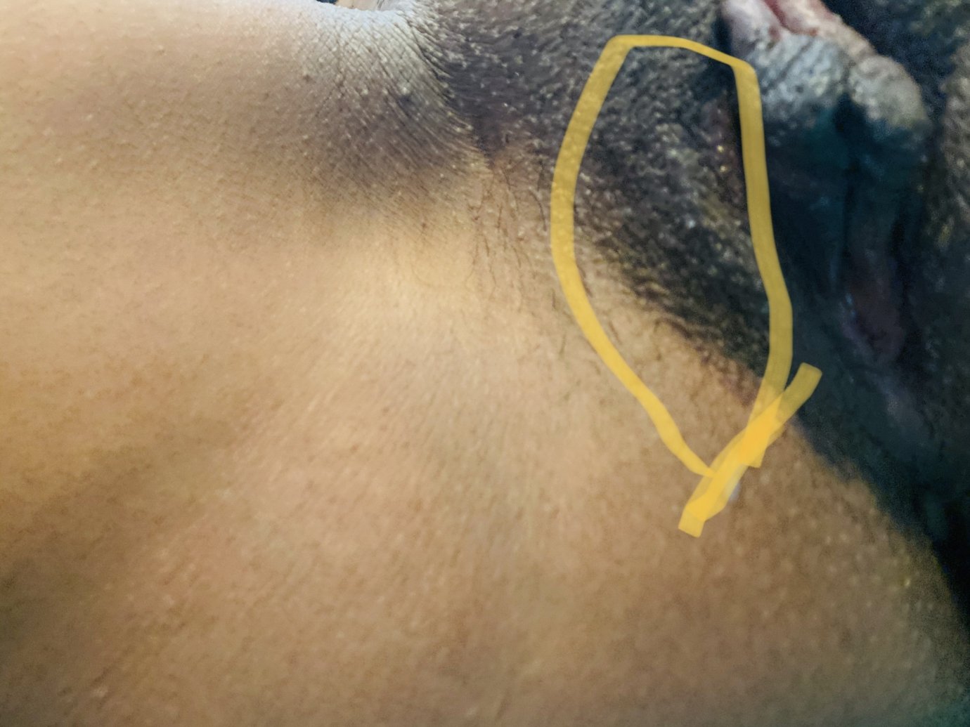 Want to know if its herpes outbreak. Pls help!!