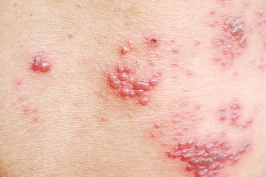 What Are Shingles? A Closer Look at the Reality of Shingles
