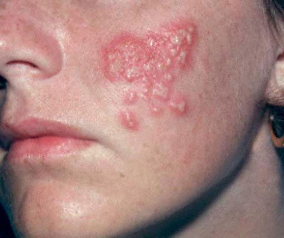 What Are the Symptoms of a First Herpes Outbreak?