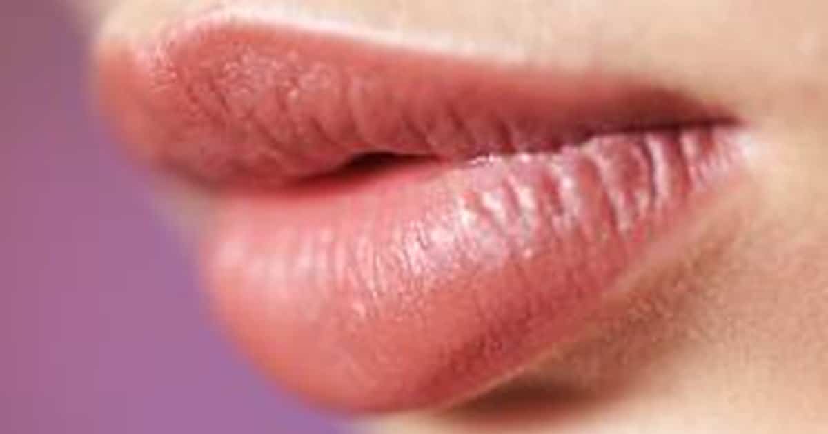 What Are the Treatments for Cheilitis?