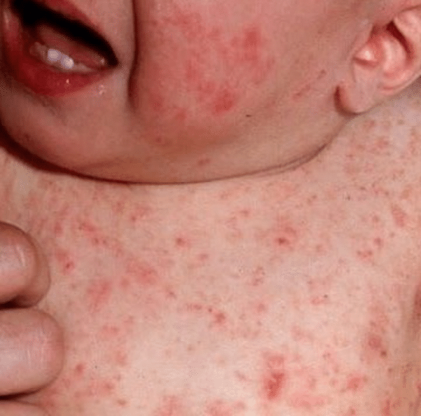 What Causes Herpes Break Out