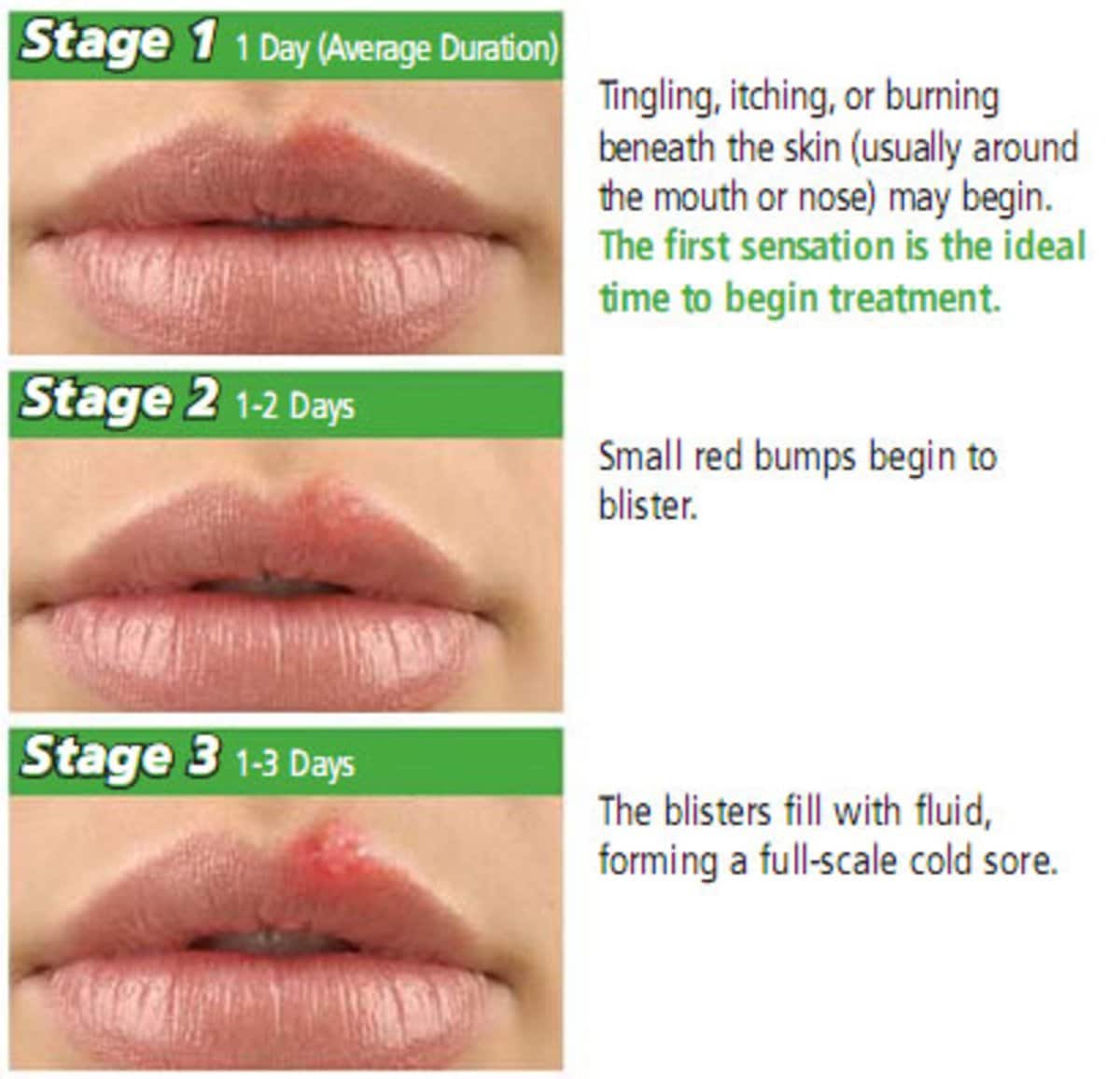 What Causes Herpes Outbreak On Lips