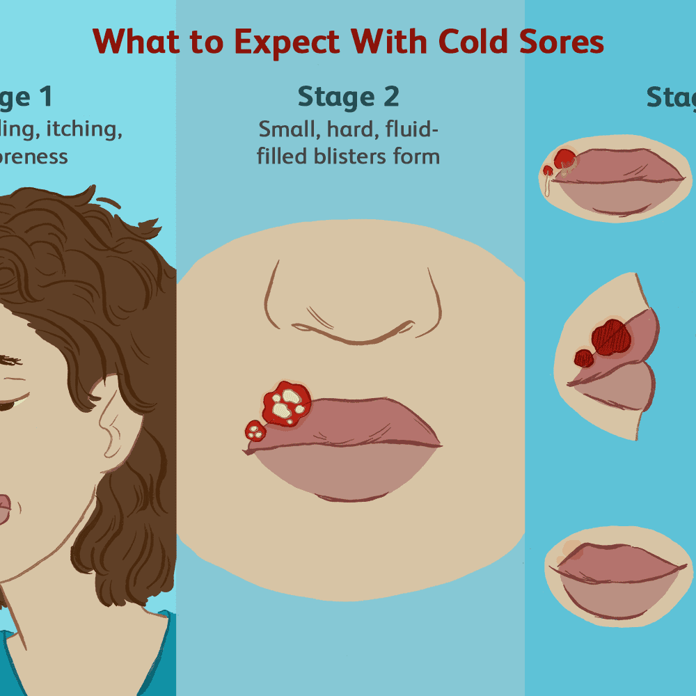 What Does A Herpe Sore Look Like Mouth ~ news word