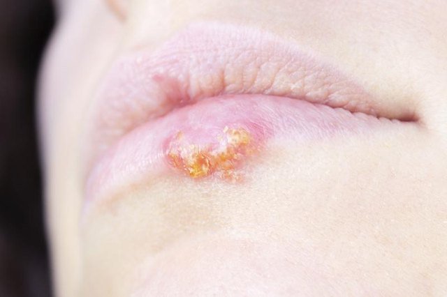 What Does Herpes Look Like in Stages?