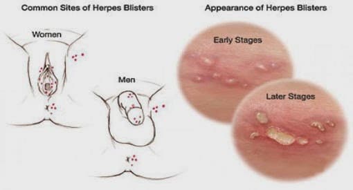 What Does Herpes Look Like? The Herpes Pictures.