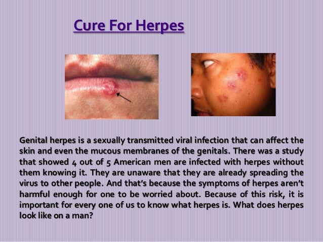 What does herpes look like