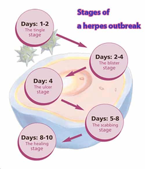 What Does Herpes Outbreak Look Like in Stages? Recognizing the Six Stages