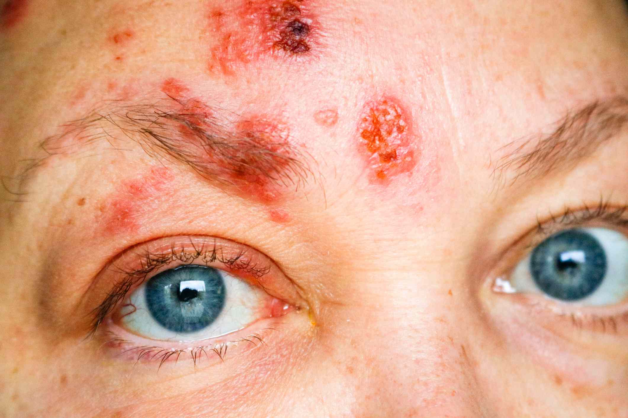 What Does Shingles Look Like: Shingles Rash Pictures