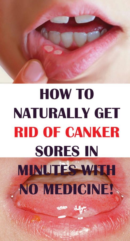 WHAT IS A CANKER SORE? Have you ever had a sore in your ...