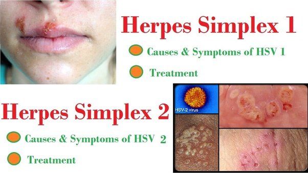 What is herpes: a virus, a fungus or a microbe?