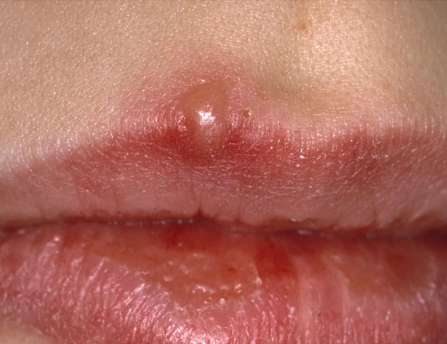 What is the difference between cold sores and mouth ulcers ...