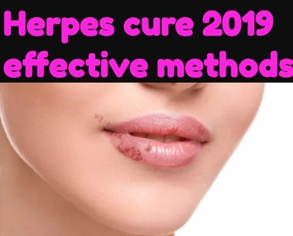 What is the treatment for herpes, and is it curable?