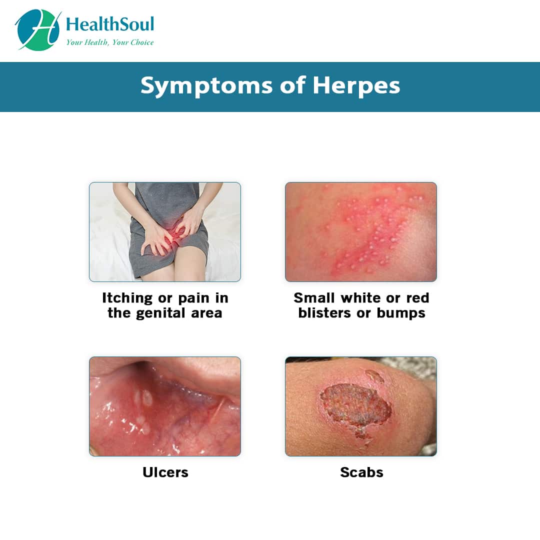 What you need to know about Herpes or HSV ? â Healthsoul
