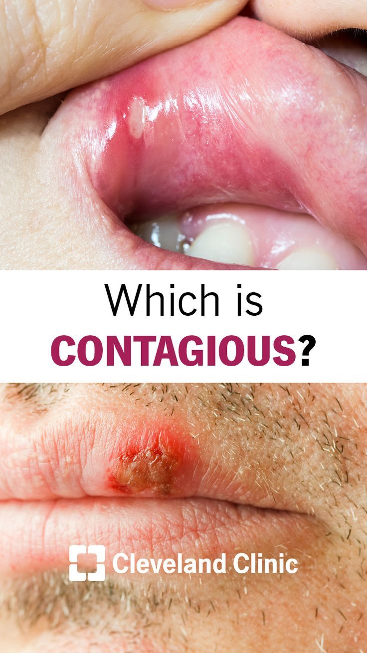 Which Is Contagious: Your Canker Sore or Cold Sore?