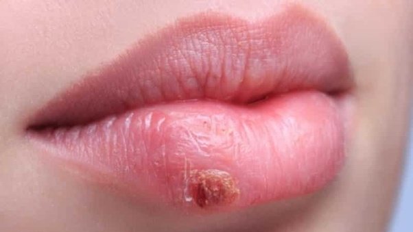 Why is a herpes infection non